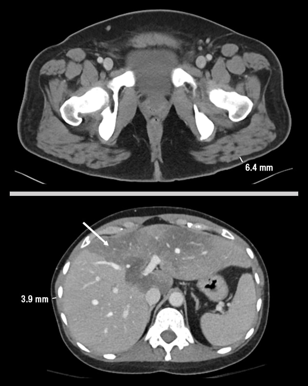 Sagittal CT images of cases 2 and 3