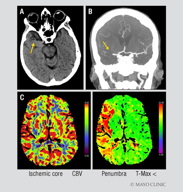 CT imaging of a woman with signs of acute ischemic stroke