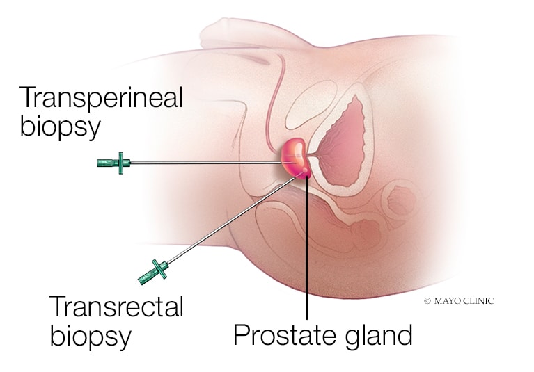 prostate cancer screening mayo clinic