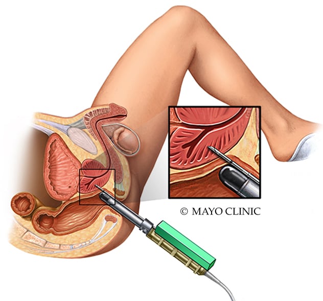 Transrectal prostate biopsy