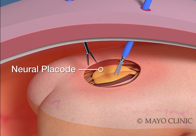 Fetoscopic repair of a myelomeningocele