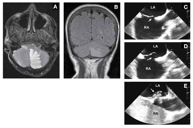 Workup images obtained with MRI and transesophageal echocardiography from a patient diagnosed with large patent foramen ovale with an atrial septum aneurysm, which was closed percutaneously.