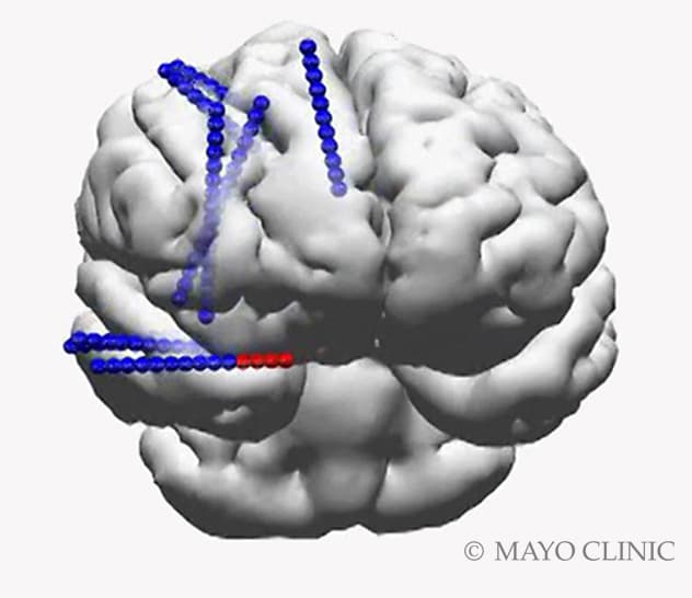 3D reconstruction shows location of implanted stereo EEG electrodes.