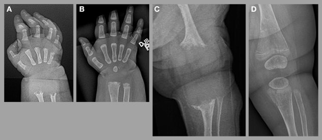 Hipofosfatasia perinatal