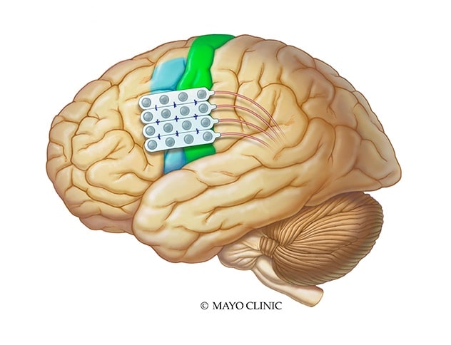 Electrode implants in chronic subthreshold cortical stimulation