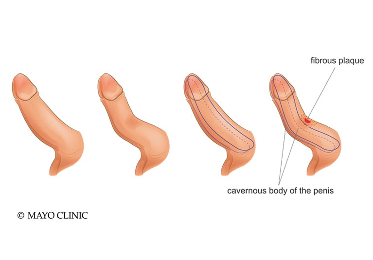 why do men s penis curve