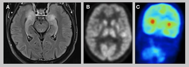 MRI and PET images of patient with autoimmune encephalitis show inflammatory changes and areas of hypermetabolism