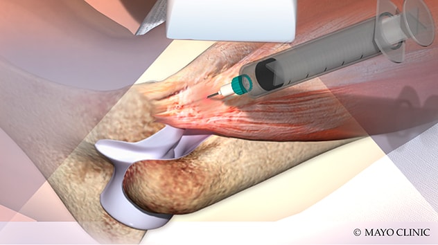 Injection of platelet-rich plasma