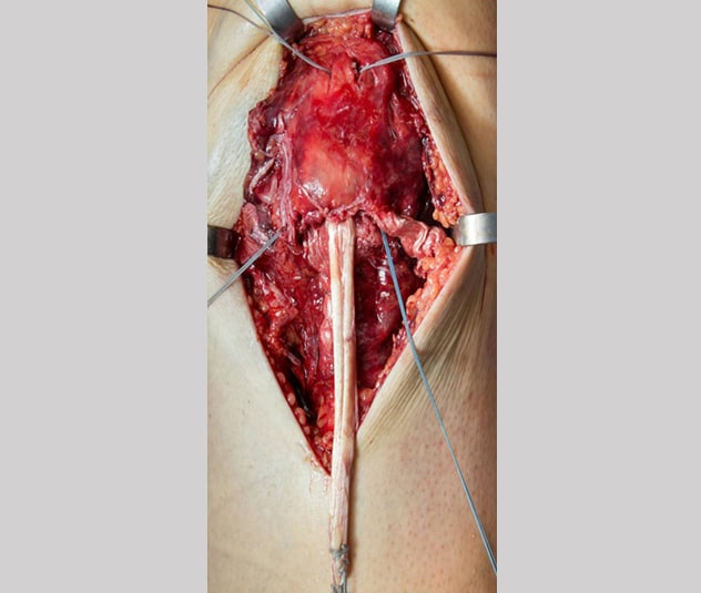 Four-stranded graft augmentation