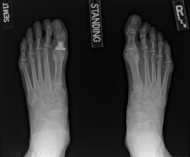 First metatarsophalangeal joint replacement before and after revision surgery