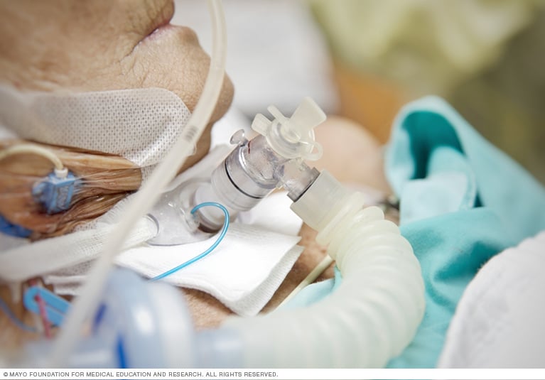 icu patient on ventilator