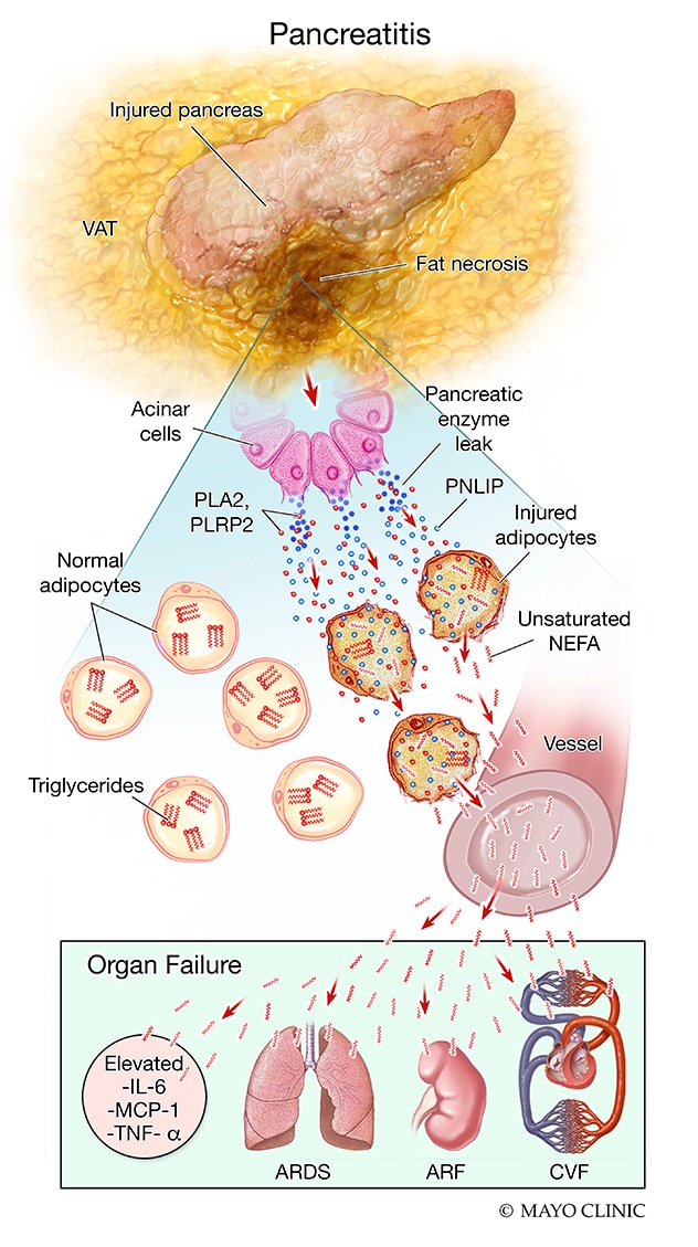 La evolución de la lesión adiposa visceral, rápida esteatonecrosis, empeoramiento de la inflamación e insuficiencia orgánica que puede ocurrir durante la pancreatitis aguda