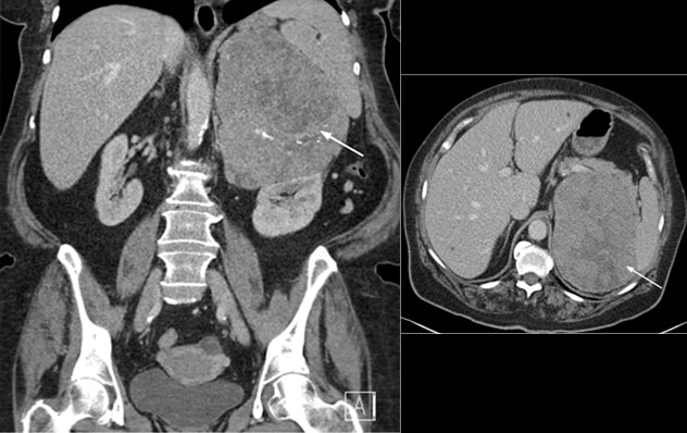 Dos vistas de un carcinoma corticosuprarrenal (caso 1)