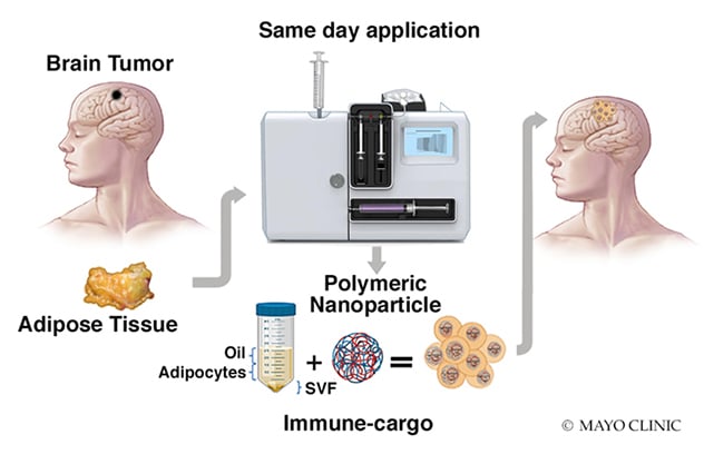 Diagram showing the process of injection of stromal vascular fraction into the surgical cavity at the time of glioblastoma resection