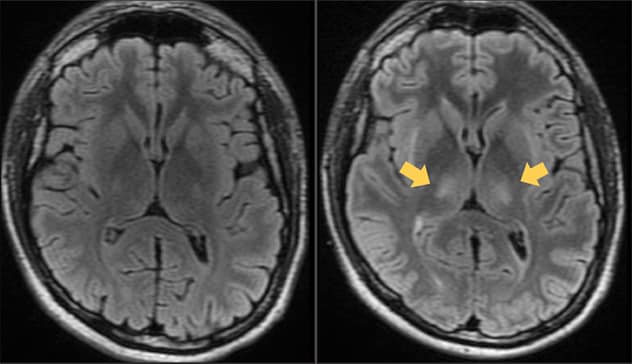 La resonancia magnética muestra el cerebro de un hombre con linfoma de células B antes y después del tratamiento con terapia de células T con CAR
