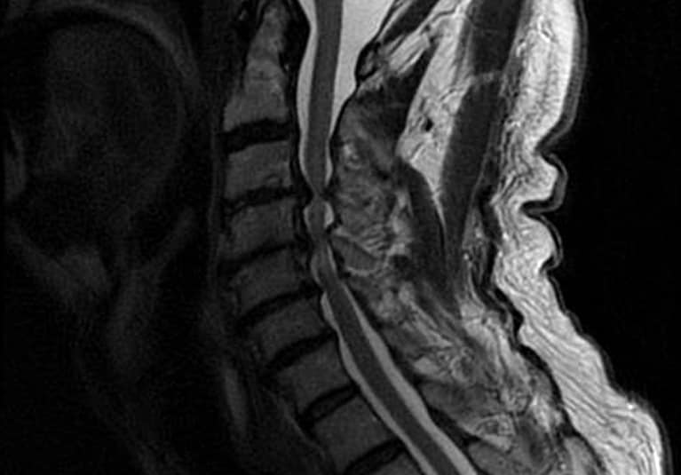 Spinal Stenosis - Neurosurgery