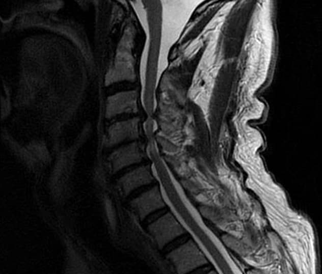Sagittal MRI of the cervical spine shows severe cord compression with cord signal change