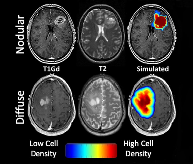 Color maps showing variance in glioblastoma cell density across the brain reflecting different extents of invasion.
