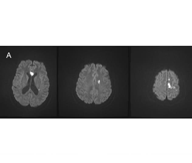 تظهر فحوصات التصوير بالرنين المغناطيسي آفات إقفارية في النصف الأيسر من الدماغ