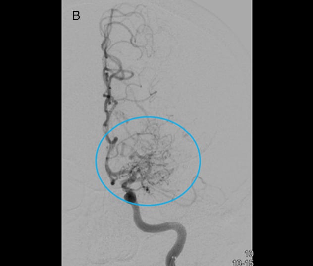 Angiogram of middle cerebral artery occlusion with moyamoya collaterals
