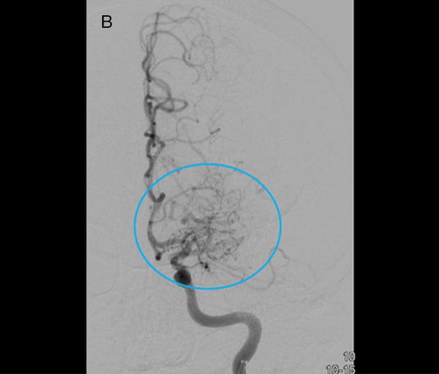 صورة وعائية لانسداد الشريان الدماغي الأوسط بجانبيات المويامويا