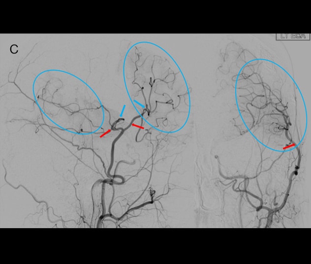 Angiogram three months after bypass surgery showing a large area of the brain supplied by the bypass