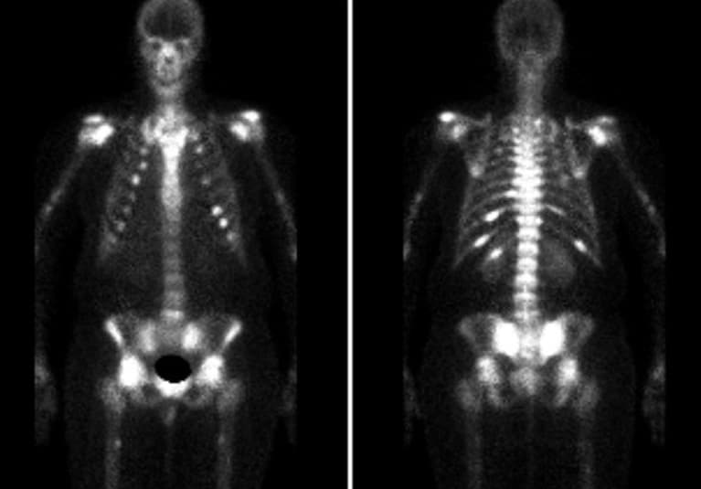 An Elusive Cause of Severe Recurrent Flank Pain: Case Quiz