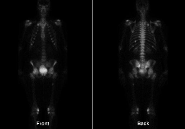 Mejora de las fracturas múltiples