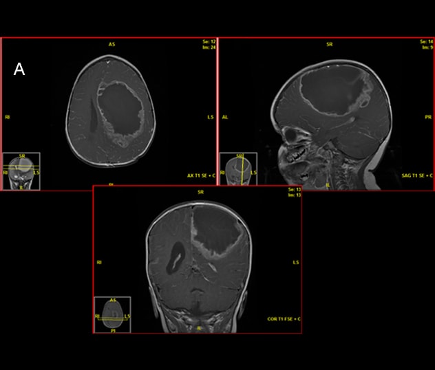 Preoperative MRI shows a high-grade ependymoma