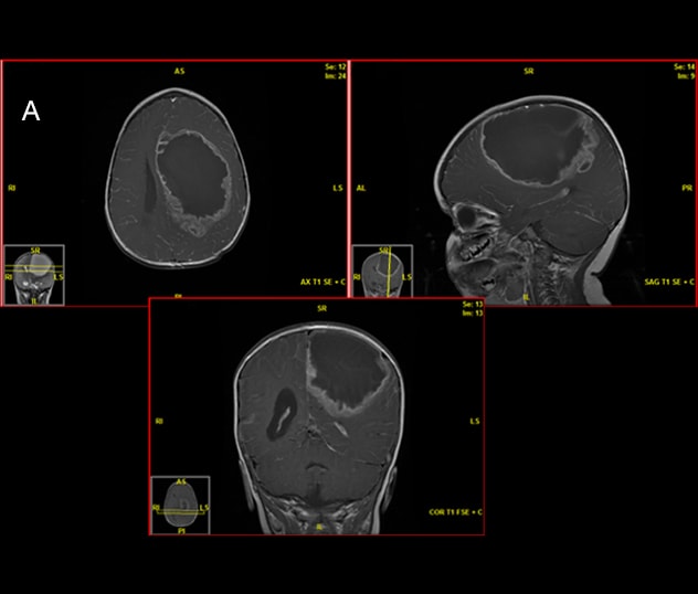 Una resonancia magnética preoperatoria muestra un ependimoma de alto grado