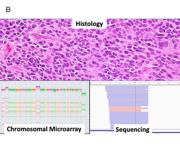 Histopathology shows an anaplastic ependymoma, with subsequent sequencing and chromosomal microarray demonstrating RELA fusion
