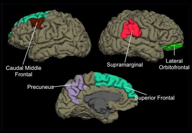 Diferencias estructurales en las regiones del cerebro que comparan migraña persistente con dolor de cabeza postraumático