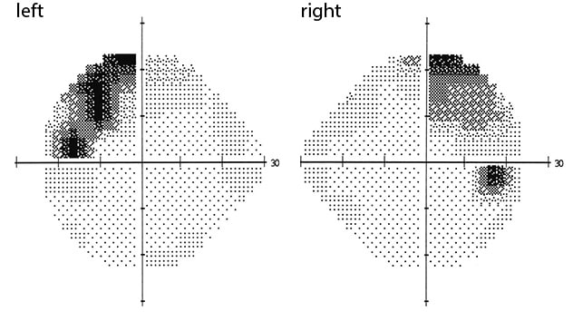 Visual field testing confirming bitemporal superior quadratanopsia