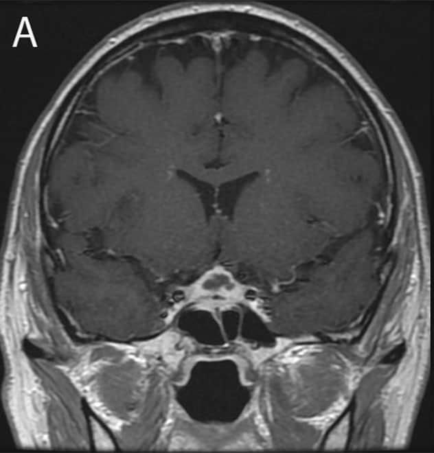 Initial presentation of soft tissue sellar mass