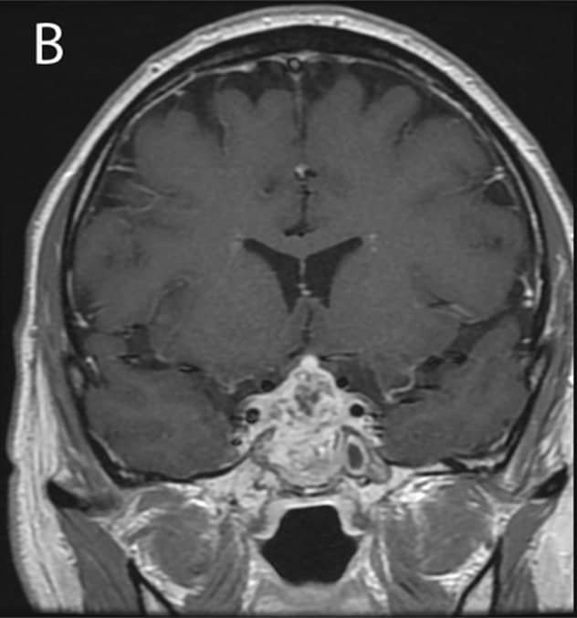 Tumor en crecimiento en la región selar a los tres meses