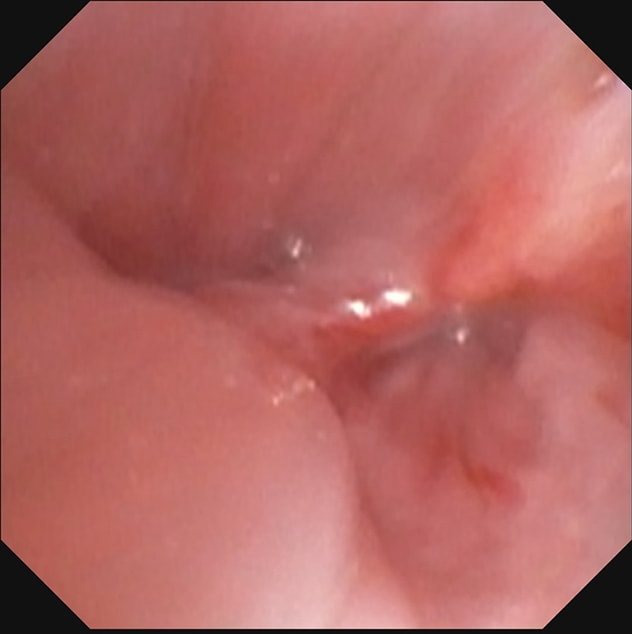 Distal left main stem bronchus
