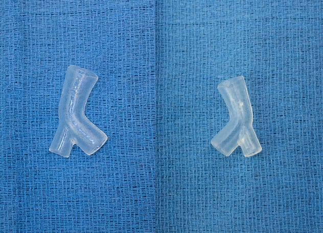 Patient-specific silicone stent