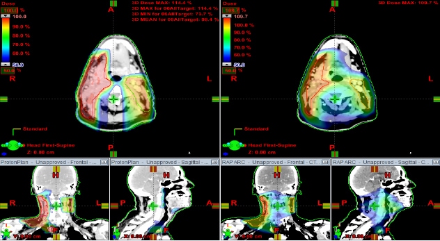 Mucosal sparing radiation after transoral surgery: protons compared with IMRT; proton beam therapy made a profound difference for study participants.