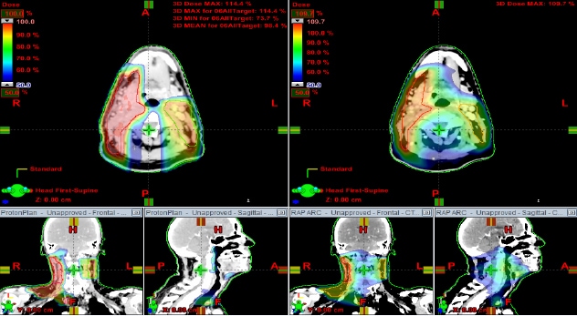 Radiación que preserva la mucosa después de una cirugía transoral: protones en comparación con radioterapia de intensidad modulada; la radioterapia de protones significó una gran diferencia para los participantes del estudio.