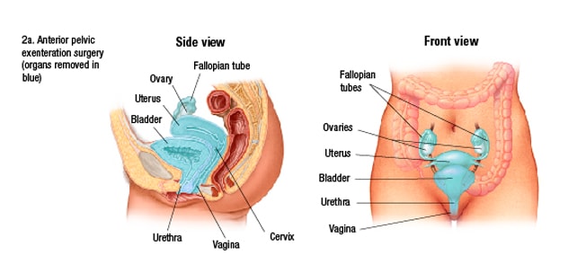 Resection in anterior exenteration