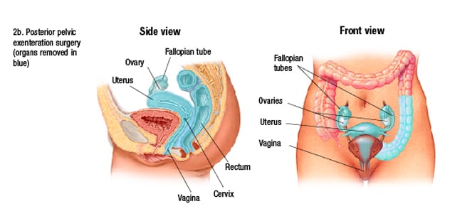 Resection in posterior exenteration