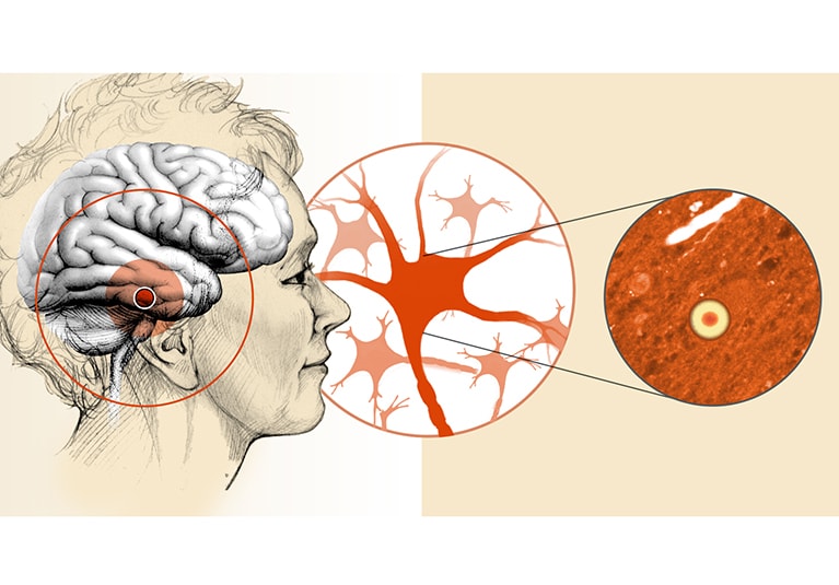 Everything You Need To Know About Lewy Body Dementia | Dr. Gurneet Singh