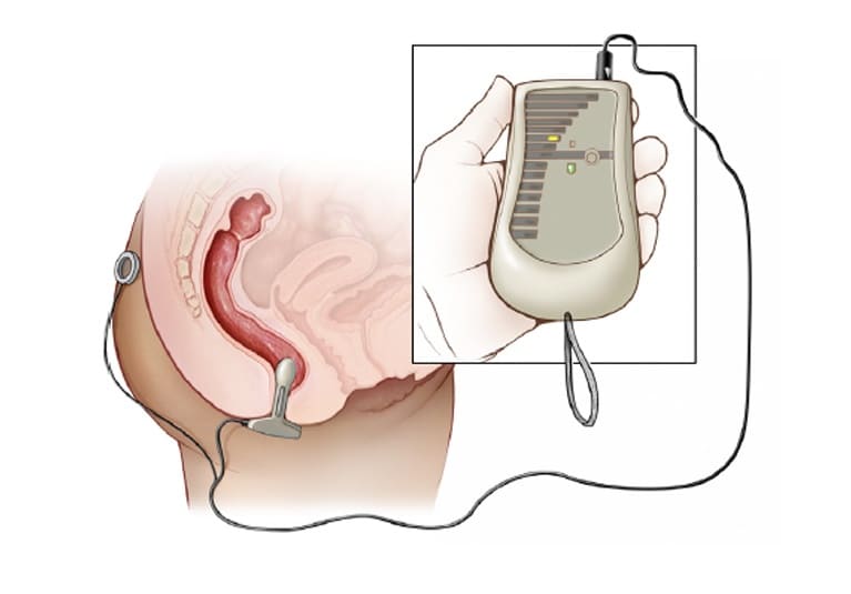 Electrical Stimulation For The Pelvic Floor - Incontinence & Prolapse