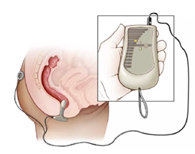 A smooth biofeedback sensor inserted in the anal canal