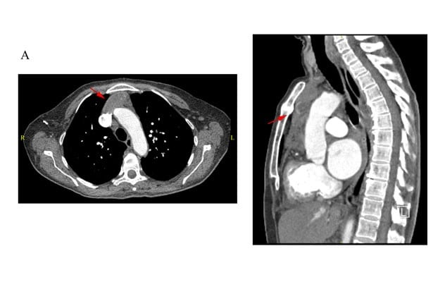 CT scan of chest at initial presentation