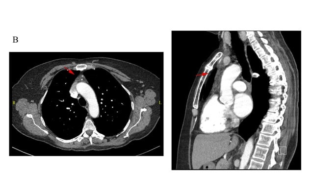 CT scan of chest at three-month follow-up