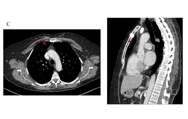 CT scan of chest at 12-month follow-up