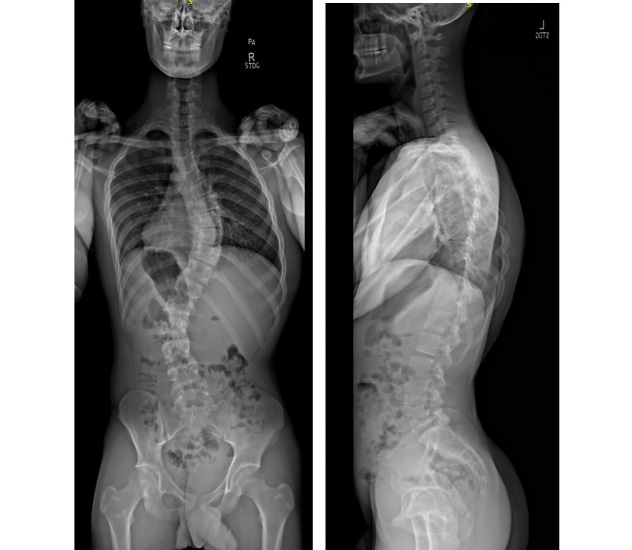 Preoperative imaging for posterior distraction-based surgery