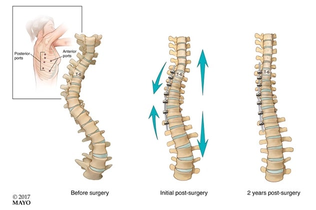 Vertebral body tethering procedure