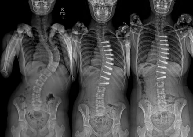 Preoperative curve and postoperative correction